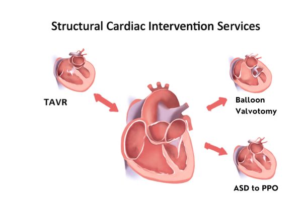 Structural Cardiac Intervention Services in Mumbai at Bombay hospital