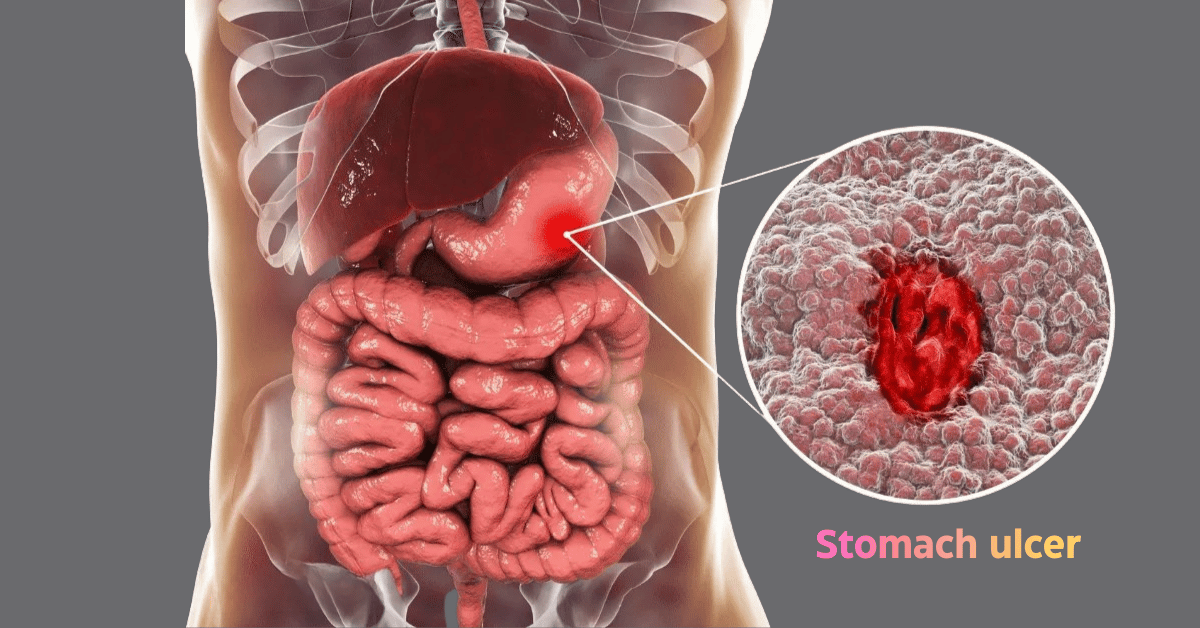 Learn What Is a Stomach Ulcer in Bombay Hospital Mumbai